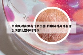 白癞风对身体有什么伤害 白癞风对身体有什么伤害北京中科可以