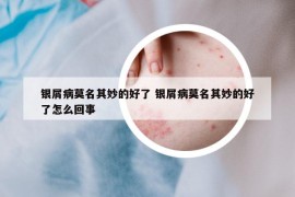 银屑病莫名其妙的好了 银屑病莫名其妙的好了怎么回事