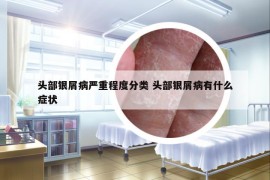 头部银屑病严重程度分类 头部银屑病有什么症状