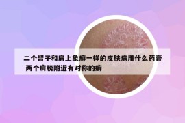 二个臂子和肩上象癣一样的皮肤病用什么药膏 两个肩膀附近有对称的癣