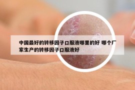 中国最好的转移因子口服液哪里的好 哪个厂家生产的转移因子口服液好