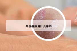 牛皮癣服用什么冲剂