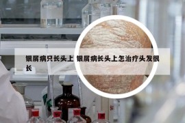 银屑病只长头上 银屑病长头上怎治疗头发很长