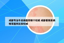 成都专治牛皮癣医院哪个权威 成都看银屑病哪家医院比较权威