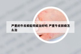 严重的牛皮癣能彻底治好吗 严重牛皮肤癣怎么治