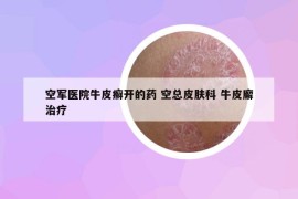 空军医院牛皮癣开的药 空总皮肤科 牛皮廨治疗