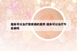 健身可以治疗银屑病的案例 健身可以治疗牛皮癣吗