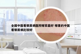 全国中医看银屑病医院哪家最好 哪里的中医看银屑病比较好