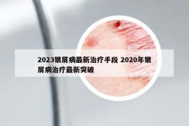 2023银屑病最新治疗手段 2020年银屑病治疗最新突破