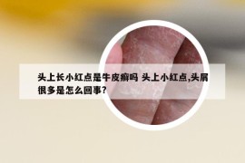 头上长小红点是牛皮癣吗 头上小红点,头屑很多是怎么回事?