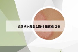 银屑病小鼠怎么取材 银屑病 生物