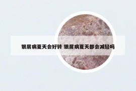 银屑病夏天会好转 银屑病夏天都会减轻吗