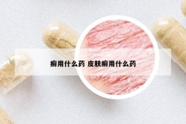 癣用什么药 皮肤癣用什么药