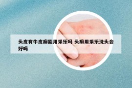 头皮有牛皮癣能用采乐吗 头癣用采乐洗头会好吗