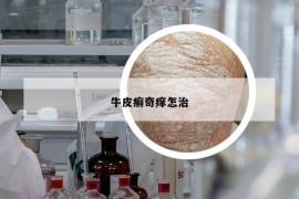 牛皮癣奇痒怎治