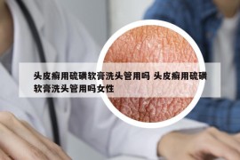 头皮癣用硫磺软膏洗头管用吗 头皮癣用硫磺软膏洗头管用吗女性