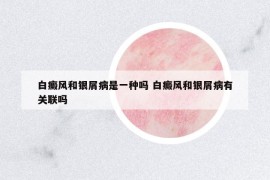 白癜风和银屑病是一种吗 白癜风和银屑病有关联吗