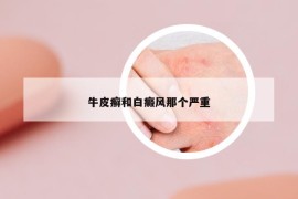 牛皮癣和白癜风那个严重
