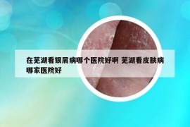 在芜湖看银屑病哪个医院好啊 芜湖看皮肤病哪家医院好