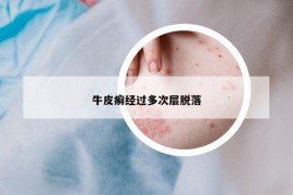 牛皮癣经过多次层脱落