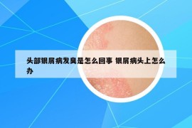 头部银屑病发臭是怎么回事 银屑病头上怎么办