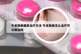 牛皮肤癣最新治疗方法 牛皮肤癣怎么治疗可以根治吗