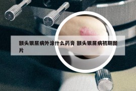 额头银屑病外涂什么药膏 额头银屑病初期图片
