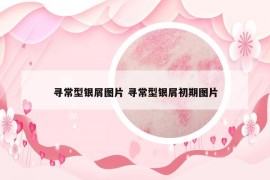 寻常型银屑图片 寻常型银屑初期图片