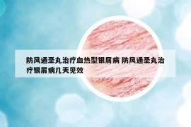 防风通圣丸治疗血热型银屑病 防风通圣丸治疗银屑病几天见效