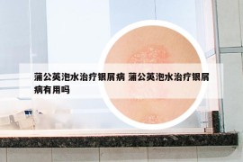蒲公英泡水治疗银屑病 蒲公英泡水治疗银屑病有用吗