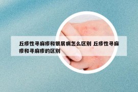 丘疹性寻麻疹和银屑病怎么区别 丘疹性寻麻疹和寻麻疹的区别