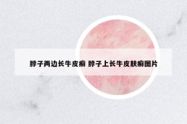 脖子两边长牛皮癣 脖子上长牛皮肤癣图片