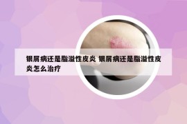银屑病还是脂溢性皮炎 银屑病还是脂溢性皮炎怎么治疗