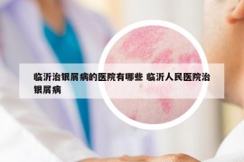临沂治银屑病的医院有哪些 临沂人民医院治银屑病