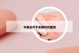 中国治疗牛皮癣好的医院