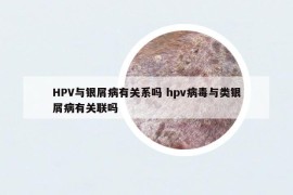 HPV与银屑病有关系吗 hpv病毒与类银屑病有关联吗