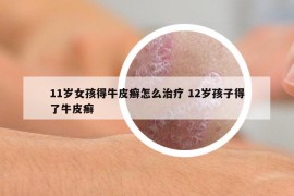 11岁女孩得牛皮癣怎么治疗 12岁孩子得了牛皮癣