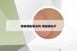 银翘病能根治吗 银翘病治疗