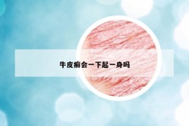 牛皮癣会一下起一身吗