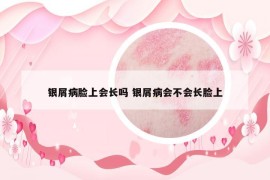 银屑病脸上会长吗 银屑病会不会长脸上