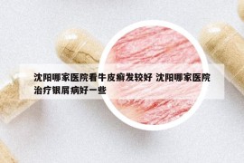 沈阳哪家医院看牛皮癣发较好 沈阳哪家医院治疗银屑病好一些