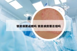 银屑病要戒糖吗 银屑病需要忌烟吗