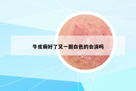 牛皮癣好了又一圈白色的会消吗