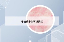 牛皮癣多久可以消红
