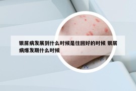银屑病发展到什么时候是往回好的时候 银屑病爆发期什么时候