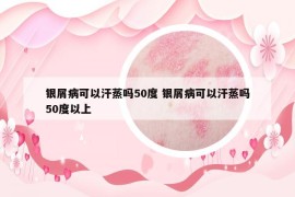 银屑病可以汗蒸吗50度 银屑病可以汗蒸吗50度以上