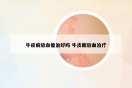 牛皮癣放血能治好吗 牛皮廨放血治疗