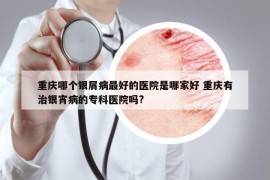 重庆哪个银屑病最好的医院是哪家好 重庆有治银宵病的专科医院吗?