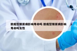 脓疱型银屑病影响寿命吗 脓疱型银屑病影响寿命吗女性