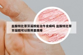 盐酸特比萘芬凝胶能治牛皮癣吗 盐酸特比萘芬凝胶可以擦阴囊瘙痒
